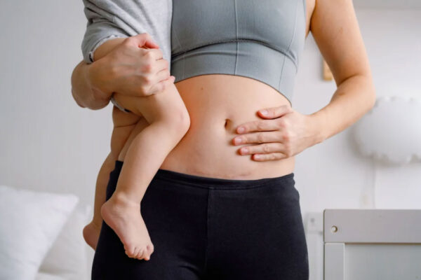diastasis-recti-how-to-heal-ab-separation-after-pregnancy